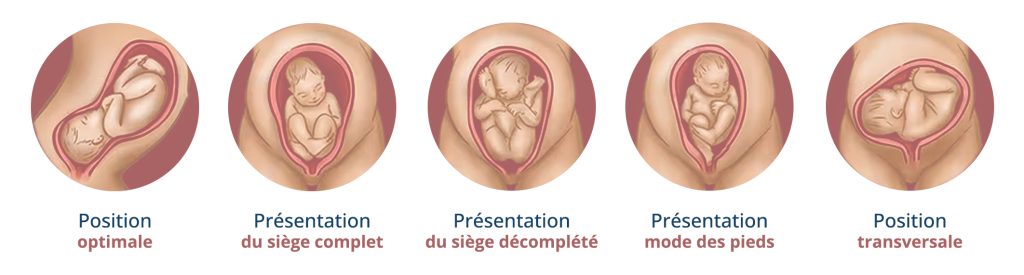 schéma des différentes positions que le bébé peut prendre dans le ventre de la maman